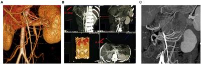 The New Concept of Physiological “Riolan’s Arch” and the Reconstruction Mechanism of Pathological Riolan’s Arch After High Ligation of the Inferior Mesenteric Artery by CT Angiography-Based Small Vessel Imaging